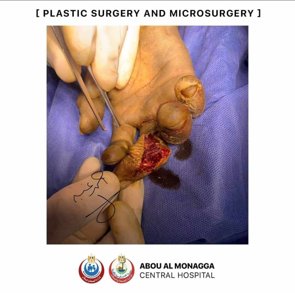 جراحة ناحجة لحالة تعاني من جرح تهتكي بمستشفى ابو المنجا بالقليوبيه 1