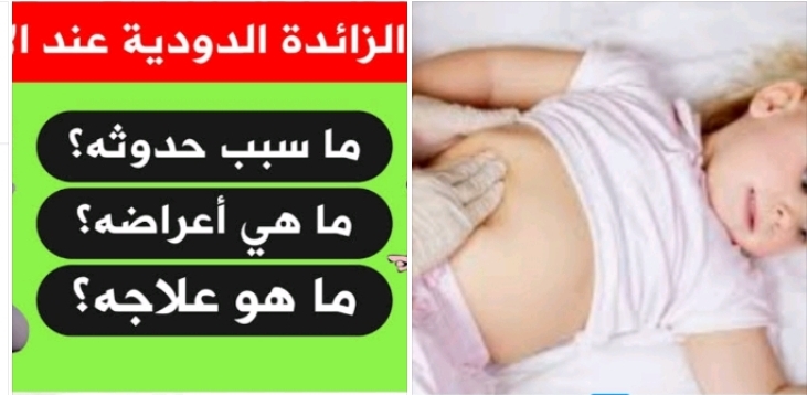 طبيبك عندنا .. الزائدة الدودية عند الاطفال بين الأسباب والاعراض وطرق العلاج 7