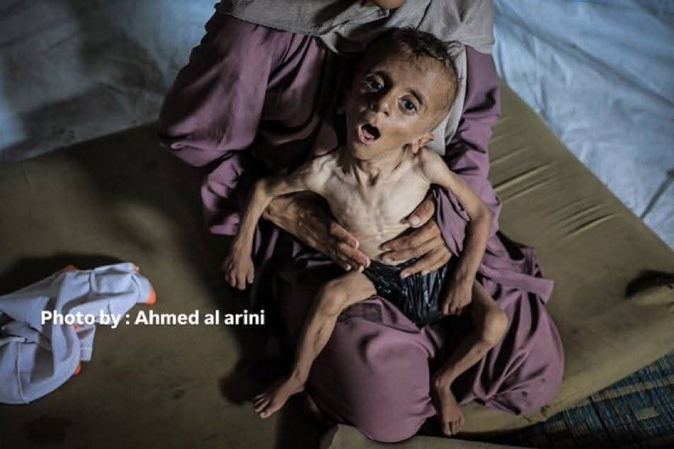 الأونروا تحذر: جيل كامل في غزة مهدد نفسيًا وصحيًا بسبب سوء التغذية وتلوث المياه
